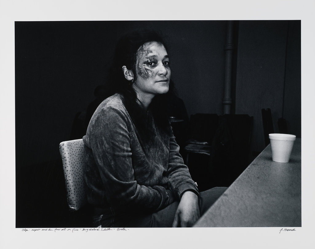 Olga, raped and her face set on fire, Long Island Shelter, Boston, 1983